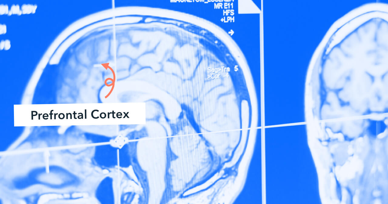 Brain x-ray with a label saying, 'prefrontal cortex' and an arrow pointing to the front of the brain.